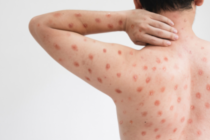 Mpox no Ceará: investigação de casos suspeitos reacende debate sobre vigilância sanitária no Brasil